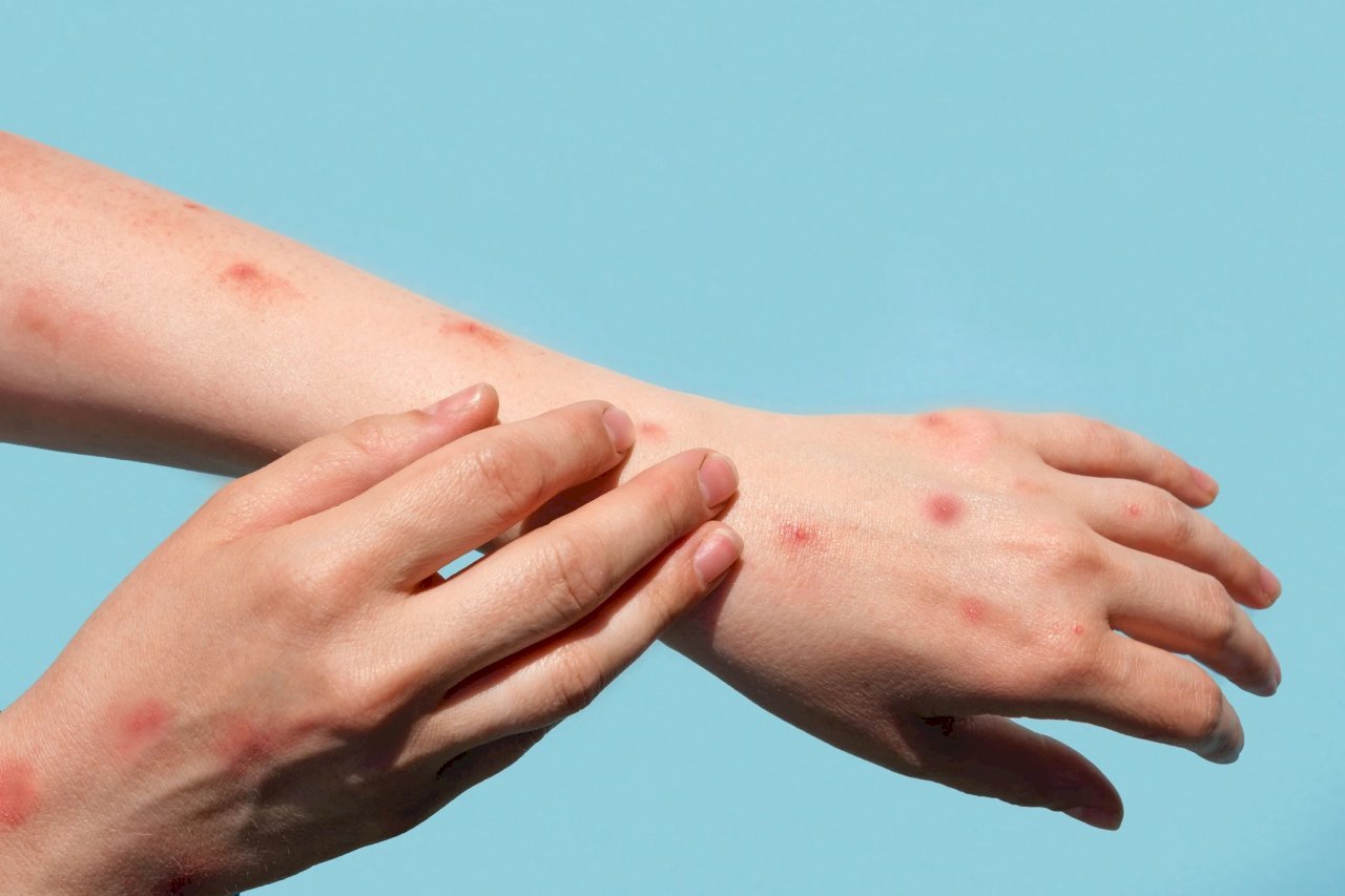 Las autoridades advierten a los viajeros del recrudecimiento de la epidemia de viruela del mono